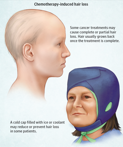 Как пережить выпадение волос после химиотерапии